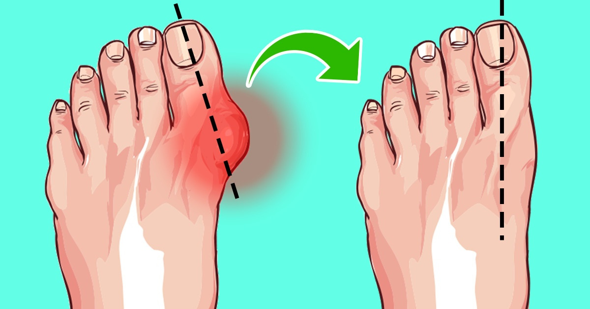 6 วิธีง่าย ๆ ในการลดอาการเท้าบวมโดยไม่ต้องผ่าตัด